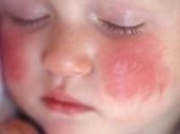 Атопический дерматит у ребенка. Симптомы и лечение
